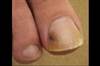 DermDx: Pigmented Area in the Nail of the Hallux DermDx: Pigmented Area in the Nail of the Hallux
