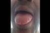 Figure 1 Quiz: Macroglossia and peripheral edema in a 65-year-old man Figure 1 Quiz: Macroglossia and peripheral edema in a 65-year-old man