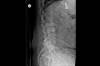 Ortho Dx: Chronic Lower Back Pain and an Incidental Abdominal Aortic Aneurysm Ortho Dx: Chronic Lower Back Pain and an Incidental Abdominal Aortic Aneurysm