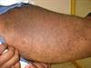 Derm Dx: Coarse Hairs on the Lower Extremity Derm Dx: Coarse Hairs on the Lower Extremity