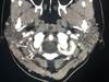 Image of the Week: Neck Pain, Headache, and Dysdiadochokinesia Image of the Week: Neck Pain, Headache, and Dysdiadochokinesia
