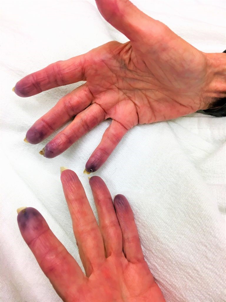 white-spots-on-fingertips