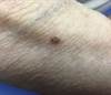 Derm Dx: Flesh-Colored Papule With Pigmented Speckles Derm Dx: Flesh-Colored Papule With Pigmented Speckles