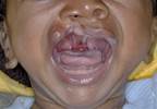 Stat Consult: Cleft Lip and Palate Stat Consult: Cleft Lip and Palate