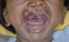 Stat Consult: Cleft Lip and Palate Stat Consult: Cleft Lip and Palate