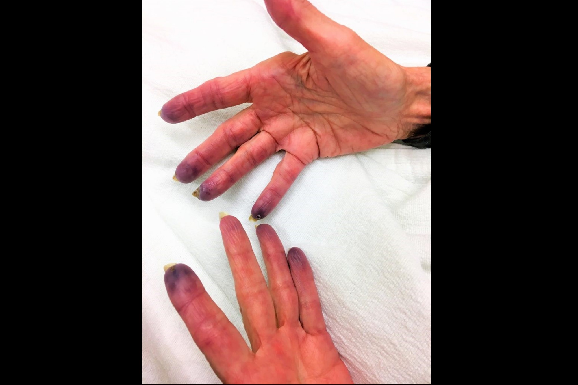 case-study-purple-fingertips-in-an-elderly-woman-the-clinical-advisor