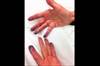 Case Study: Purple Fingertips in an Elderly Woman Case Study: Purple Fingertips in an Elderly Woman