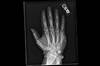Ortho Dx: Open Fracture of the Hand Ortho Dx: Open Fracture of the Hand