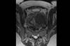 Image of the Week: Worsening Stress Urinary Incontinence in a 62-Year-Old Woman Image of the Week: Worsening Stress Urinary Incontinence in a 62-Year-Old Woman