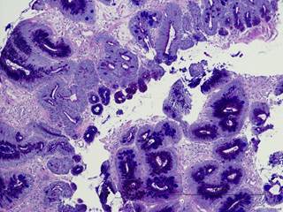 Aspirin and high-dose esomeprazole may improve outcomes in individuals with Barrett esophagus, the greatest risk factor for esophageal adenocarcinoma. Aspirin and high-dose esomeprazole may improve outcomes in individuals with Barrett esophagus, the greatest risk factor for esophageal adenocarcinoma.