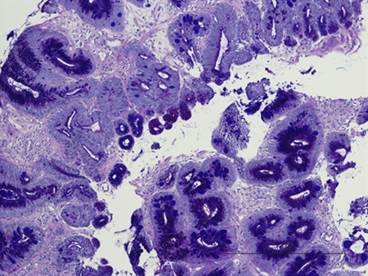 Proton Pump Inhibitor Treatment and Aspirin Improve Outcomes in Barrett Esophagus Proton Pump Inhibitor Treatment and Aspirin Improve Outcomes in Barrett Esophagus