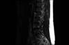 Ortho Dx: Lower Back Pain in a 16-Year-Old Male Athlete Ortho Dx: Lower Back Pain in a 16-Year-Old Male Athlete