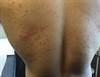 Derm Dx: Dermatitis on the Torso of a Baseball Player Derm Dx: Dermatitis on the Torso of a Baseball Player