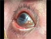 Image of the Week: Thin Film on the Cornea of an Elderly Woman Image of the Week: Thin Film on the Cornea of an Elderly Woman