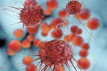 Investigational Therapy Gets Fast Track Status for Recurrent Ovarian Cancer Investigational Therapy Gets Fast Track Status for Recurrent Ovarian Cancer