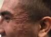 Derm Dx: Rash on the Cheek and Scalp Derm Dx: Rash on the Cheek and Scalp