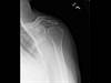 Ortho Dx: Persistent Shoulder Pain Ortho Dx: Persistent Shoulder Pain