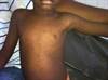 Image of the Week: Erythematous Rash and Fever Image of the Week: Erythematous Rash and Fever