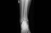 Ortho Dx: Right Ankle Pain Following Sports Injury Ortho Dx: Right Ankle Pain Following Sports Injury