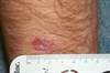 Derm Dx: Asymptomatic Lesion on the Forearm Derm Dx: Asymptomatic Lesion on the Forearm