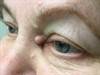 Derm Dx: Flesh-Colored Nodule in the Left Medial Canthus Derm Dx: Flesh-Colored Nodule in the Left Medial Canthus