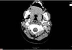 Prevertebral Swelling From Puncture Prevertebral Swelling From Puncture