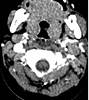 Prevertebral Swelling From Puncture Prevertebral Swelling From Puncture