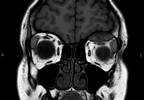 Subperiosteal Orbital Hematoma Subperiosteal Orbital Hematoma