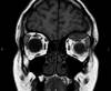 Subperiosteal Orbital Hematoma Subperiosteal Orbital Hematoma