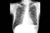 <i>Mycobacterium Tuberculosis</i> Infection <i>Mycobacterium Tuberculosis</i> Infection
