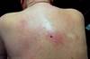 Hyperpigmentation of the Upper Back Hyperpigmentation of the Upper Back