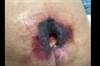 Kennedy Terminal Ulcer Kennedy Terminal Ulcer