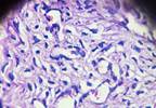 Quantitative Image Marker Beneficial for Identifying Response to Postsurgical Chemotherapy in Ovarian Cancer Quantitative Image Marker Beneficial for Identifying Response to Postsurgical Chemotherapy in Ovarian Cancer