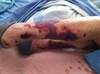 Image of the Week: Painful Lesions on the Lower Limbs and Ears Image of the Week: Painful Lesions on the Lower Limbs and Ears