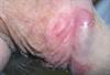 Derm Dx: Asymptomatic Genital Rash Derm Dx: Asymptomatic Genital Rash