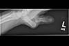 Ortho Dx: Left Thumb Pain and Deformity Ortho Dx: Left Thumb Pain and Deformity