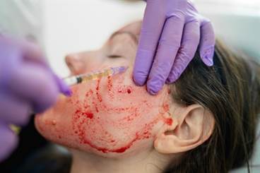Patrons of 'Vampire Facial' Spa May Have Been Exposed to HIV Patrons of 'Vampire Facial' Spa May Have Been Exposed to HIV