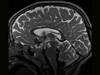 Image of the Week: Seizures and Spontaneous Laughter in a Child Image of the Week: Seizures and Spontaneous Laughter in a Child