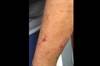 Derm Dx: Dark Spots on the Arms Derm Dx: Dark Spots on the Arms