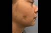 Facial Plaques Following Acne Treatment Facial Plaques Following Acne Treatment