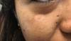 Hypopigmented Lesion With Vanishing Mole Hypopigmented Lesion With Vanishing Mole
