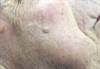 Derm Dx: Flesh-Colored Growth on the Cheek Derm Dx: Flesh-Colored Growth on the Cheek