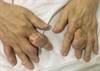 Image of the Week: Fever and Swollen, Erythematous Nodules in the Fingers Image of the Week: Fever and Swollen, Erythematous Nodules in the Fingers