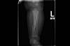 Ortho Dx: Suspected Child Abuse Ortho Dx: Suspected Child Abuse