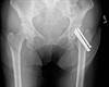Ortho Dx: Failed Hip Pinning Ortho Dx: Failed Hip Pinning