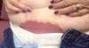 Derm Dx: Rash on the Lower Abdomen and Groin Derm Dx: Rash on the Lower Abdomen and Groin
