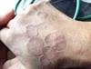 Image of the Week: Ring-Shaped Lesions on the Hands Image of the Week: Ring-Shaped Lesions on the Hands