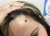 Derm Dx: A Bleeding Mole on the Forehead Derm Dx: A Bleeding Mole on the Forehead
