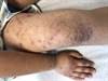 Red-Brown Papules on the Extremities Red-Brown Papules on the Extremities