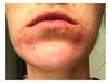A Burning, Acneiform Facial Eruption A Burning, Acneiform Facial Eruption